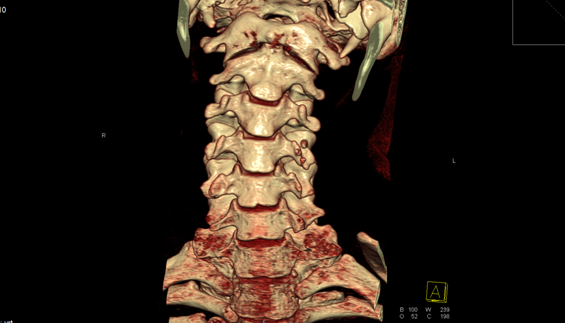 Кт шейного отдела позвоночника фото